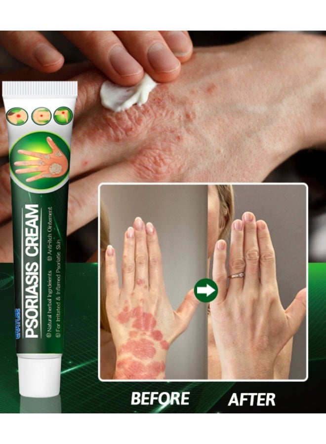 إيرايسي كريم لعلاج الصدفية - مستخلصات نباتية عشبية - عناية بالبشرة المصابة بالصدفية - تخفيف صدفية اليدين والقدمين - تخفيف الحكة - مكونات طبيعية - مرطب ومغذي - 20 غرام - Image 2